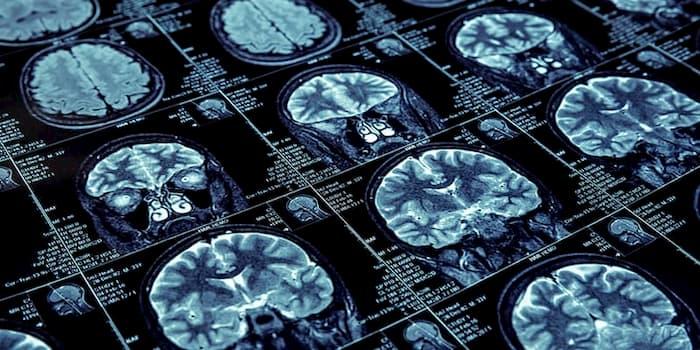 MCI due to Alzheimer's Disease Clinical Tool